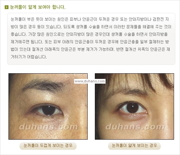 [두한성형외과 경쟁력 눈성형] - [눈성형, 쌍꺼풀 수술 방법에 관한 자주하는 질문과 답변 안내] 관련 이미지 4