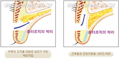 [Duhan Plastic Surgery Reoperation for Double Eyelids] - [Lowering the Double Eyelid Line] image 34