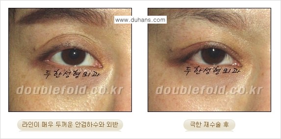 [두한성형외과 NO.1 경쟁력 눈성형] - [일반 쌍꺼풀 재수술과 극한 눈(쌍꺼풀) 재수술과의 차이점] 관련 이미지 4