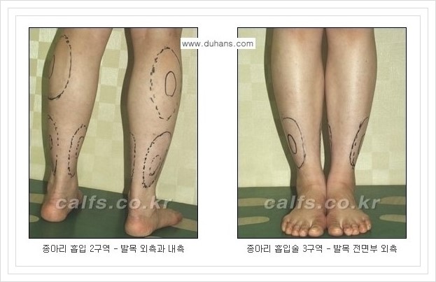 [두한성형외과 경쟁력 멀티종아리성형] - [종아리성형 방법별 전후 주의사항] 관련 이미지 21