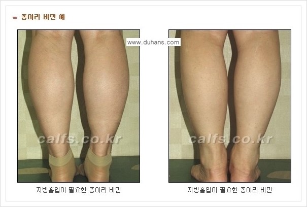 [두한성형외과 경쟁력 멀티종아리성형] - [예쁜 종아리를 만드는 종아리 지방흡입술 안내] 관련 이미지 1