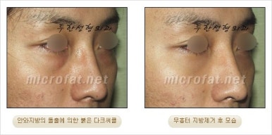두한성형외과 눈밑수술 - 다크서클 수술 전후 관리 안내 관련 이미지 70