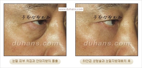 [두한성형외과 경쟁력 다크써클 교정] - [젊어 보이면서 개선된 인상을 주는 하안검 성형술] 관련 이미지 14