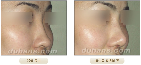 [두한성형외과 코성형] - [코재수술 방법] 관련 이미지 29