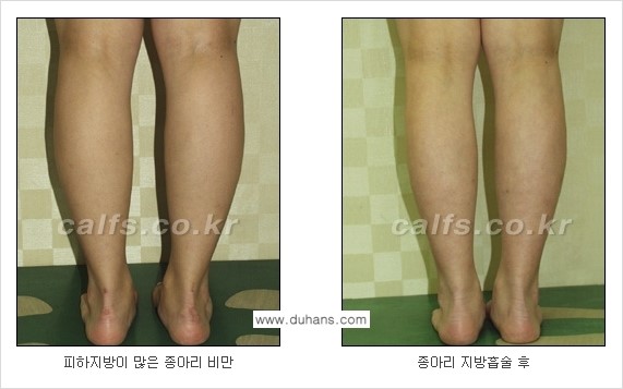 [두한성형외과 경쟁력 멀티종아리성형] - [종아리(다리) 비만 해결 방법 안내] 관련 이미지 9