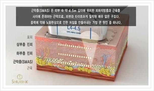 [두한성형외과 경쟁력 주름성형] - [HIFU 초음파 리프팅 주름교정술 안내 2.] 관련 이미지 13