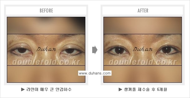 [두한성형외과 쌍꺼풀 재수술] - [쌍꺼풀 재수술에서 잘못된 수술로 인한 넓어진 흉터 처리 문제] 관련 이미지 7