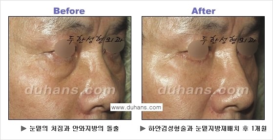 [두한성형외과의 상큼하고 환한 젊은 눈매완성] - [하안검 성형술 ②] 관련 이미지 2