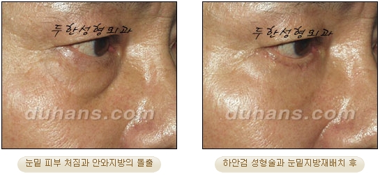 [Duhan Plastic Surgery Ophthalmic Plastic Surgery] - [Lower Blepharoplasty] image 34