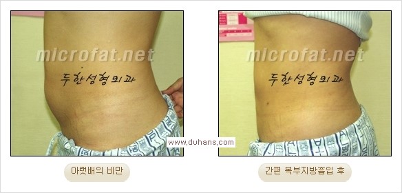 [두한성형외과 경쟁력 간편지방흡입] - [복부(뱃살) 비만 간편지방흡입] 관련 이미지 16