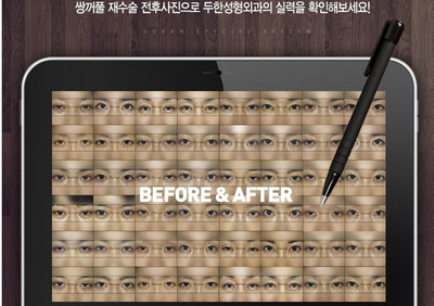 [Duhan Plastic Surgery Double Eyelid Revision Surgery] - [Correcting the Double Eyelid Line in Sunken Eyelids] image 60