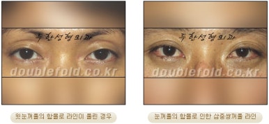 [Duhan Plastic Surgery Double Eyelid Revision Surgery] - [Correcting the Double Eyelid Line in Sunken Eyelids] image 3