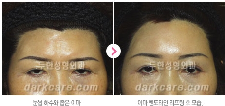 Duhan Plastic Surgery Combo Program - Dark Circles and Lifting image 24