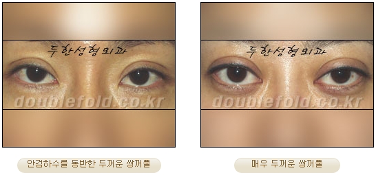 [두한성형외과 쌍커풀재수술] - [심한 소세지눈, 두줄따기, 쌍꺼풀 흉터] 관련 이미지 4