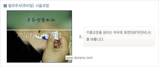 [두한성형외과 경쟁력 퀵성형] - [필러주사(쥬비덤)으로  간단하고 빠르게 주름교정] 관련 이미지 8