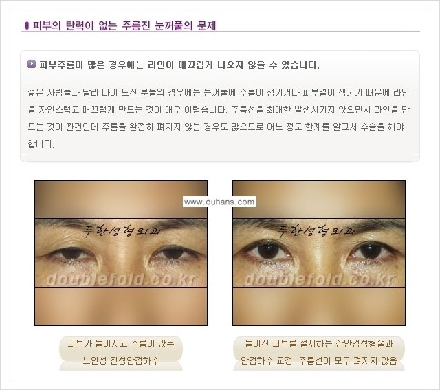 [두한성형외과 경쟁력 쌍꺼풀 재수술(극한 재수술)] - [쌍꺼풀 재수술에서 극복해야 할 여러 가지 상황과 문제점들 안내] 관련 이미지 7