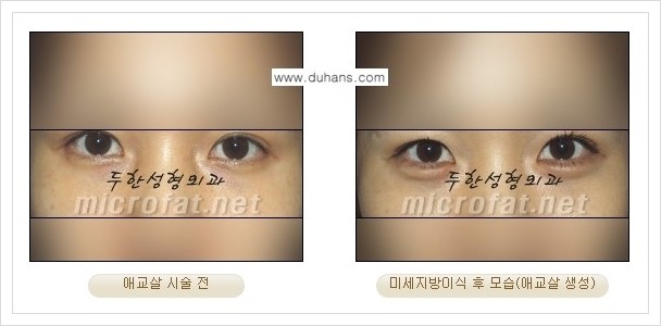 [두한성형외과 경쟁력 눈밑성형] - [눈밑 애교살 시술 안내 1.] 관련 이미지 6