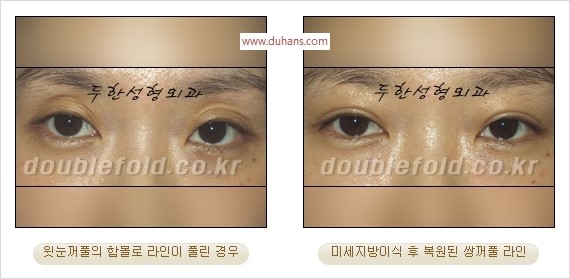 [두한성형외과 경쟁력 쌍꺼풀 재수술 리더] - [풀린 쌍꺼풀, 풀려버린 쌍꺼풀 재수술 방법 안내] 관련 이미지 9