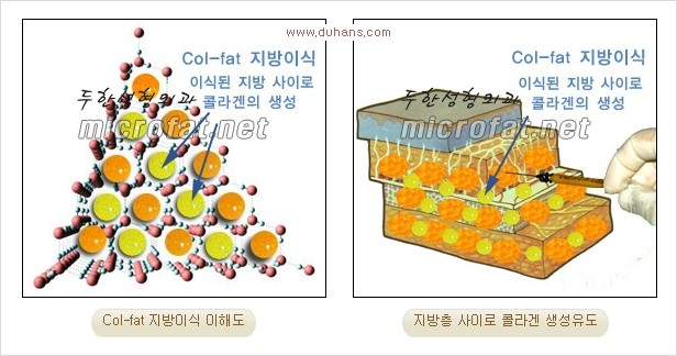 ⁠[두한성형외과 경쟁력 미세지방이식] - [상표등록 "Col-fat(콜펫) 지방이식"으로 교정이 가능한 부위] 관련 이미지 1