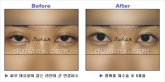 [두한성형외과 경쟁력 쌍꺼풀 재수술] - [안검하수 성형 흔한 질문과 답변 모음] 관련 이미지 4