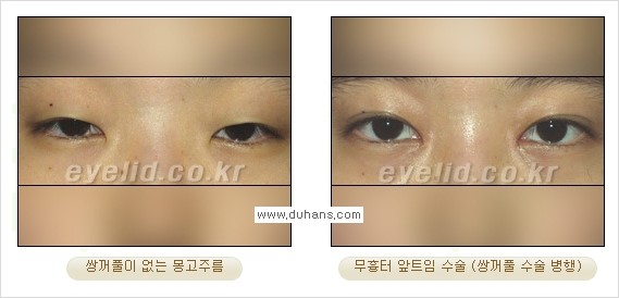[두한성형외과 경쟁력 눈성형] - [안검하수와 몽고주름에 대한 자주하는 질문과 답변] 관련 이미지 17