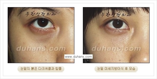 [두한성형외과 경쟁력 눈밑성형] - [꺼진 눈밑, 눈밑 함몰 주름선 눈밑 미세지방이식 안내] 관련 이미지 15