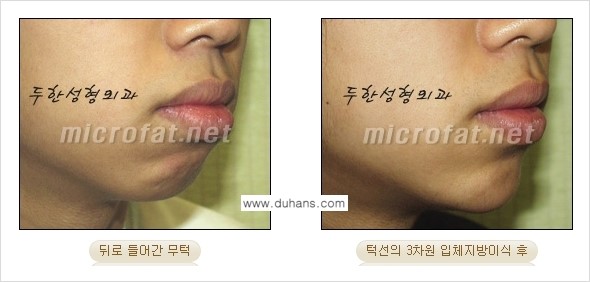 [두한성형외과의 경쟁력 미세지방이식] - [무턱교정 - 턱 미세지방이식 안내 2.] 관련 이미지 16