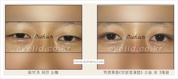 [두한성형외과 경쟁력 눈성형, 쌍꺼풀 수술] - [퀵쌍꺼풀(부분절개법)의 수술 안내] 관련 이미지 17