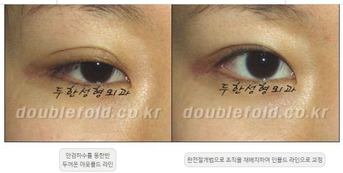 [Double Eyelid Surgery Duhan Plastic Surgery] - [Revision Methods] image 3