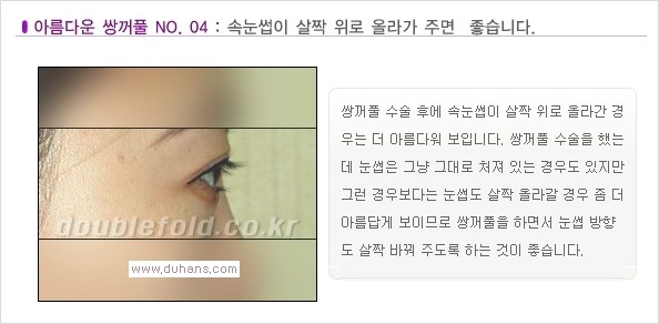 [두한성형외과 경쟁력 쌍꺼풀 재수술, 극한 재수술] - [Dr. 컬럼 - 아름다운 눈매의 조건이란?] 관련 이미지 5