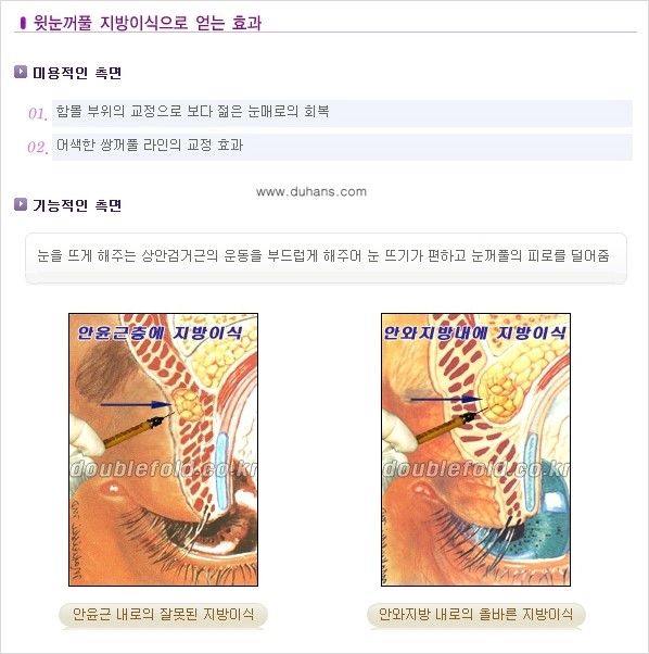 [두한성형외과 NO.1 눈성형] - [함몰된(꺼진) 눈꺼풀에서 쌍꺼풀 라인 교정 1.] 관련 이미지 5