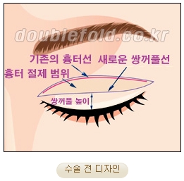 [두한성형외과 쌍커풀재수술] - [심한 소세지눈, 두줄따기, 쌍꺼풀 흉터] 관련 이미지 8