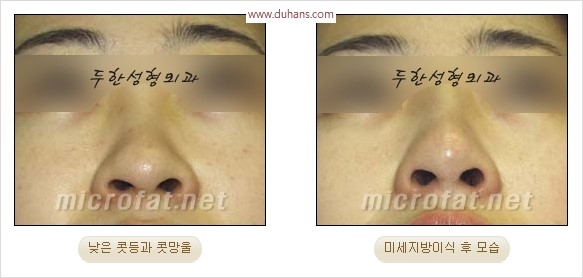 [두한성형외과 경쟁력 코성형 리더] - [자연스럽고 오똑한 콧망울! 코성형 방법]​ 관련 이미지 46