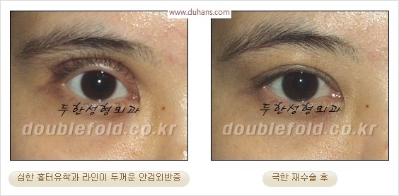 [두한성형외과 경쟁력 눈성형] - [극한 재수술, 함몰된 눈꺼풀 라인교정, 안검하수(졸리운 눈매)] 관련 이미지 14