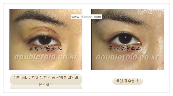 [두한성형외과 경쟁력 쌍꺼풀 재수술, 극한 눈재수술] - [쌍꺼풀 재수술, 극한 눈재수술 관련 자주하는 질문과 답변] 관련 이미지 5