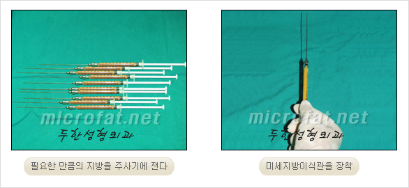 [두한성형외과 경쟁력 안면윤곽 성형 리더] - [완변한 V 라인! 턱 미세지방이식, 볼살 미세지방이식, 사각턱 보톡스 안내] 관련 이미지 10
