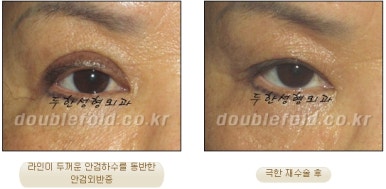 쌍꺼풀수술 두한성형외과 - 쌍커풀재수술의 문제점 관련 이미지 23
