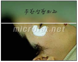 [Duhan Plastic Surgery Wrinkle Improvement] - [Wrinkle Filler Procedure] image 4