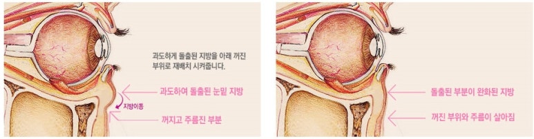 두한성형외과 다크서클 - 눈밑 다크서클 치료방법 관련 이미지 13