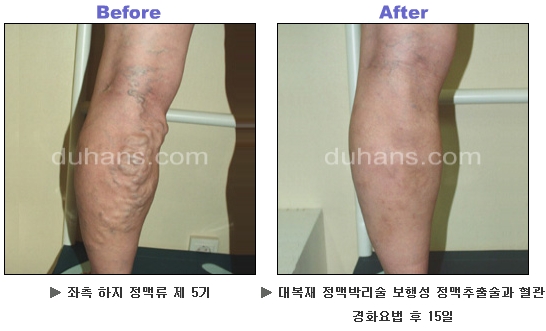 [두한성형외과 정맥류] - [하지정맥류, 정맥확장증, 혈관확장증] 관련 이미지 28