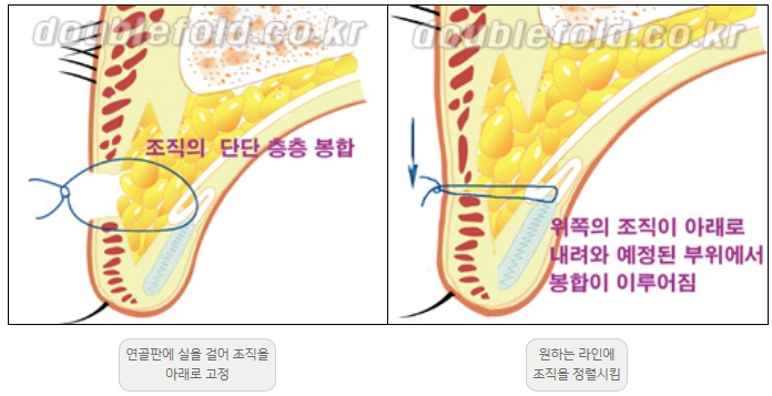 [Duhan Plastic Surgery Double Eyelid Revision] - [Thick Double Eyelid Line] image 8