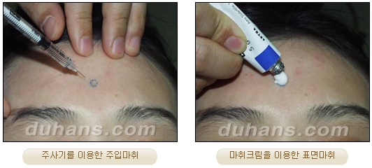 [Duhan Plastic Surgery Double Eyelid Surgery] - [Types of Double Eyelid Surgery] image 44