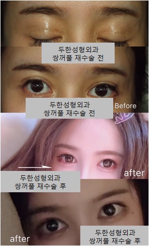 [두한성형외과 쌍꺼풀재수술]-[#인아웃라인 #라인낮추기 #앞트임흉터 #흉터제거 #앞트임흉터제거] 관련 이미지 1