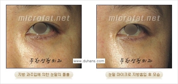​[두한성형외과 가을엔 지방흡입을] - [볼살, 눈밑, 턱선 초음파 미세지방흡입] 관련 이미지 9