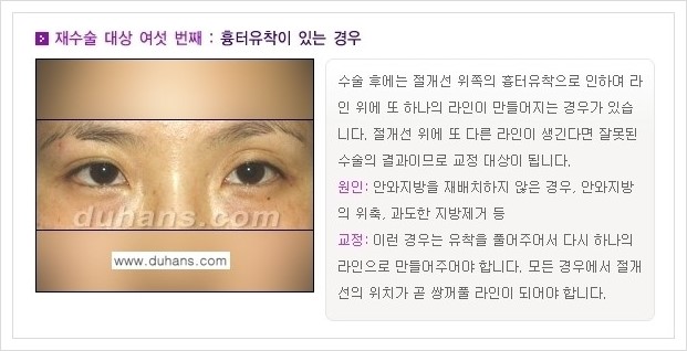 [두한성형외과 경쟁력 쌍꺼풀 재수술(극한 재수술)] - [쌍꺼풀 재수술 대상의 안내] 관련 이미지 6