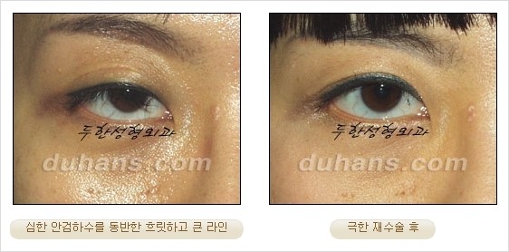 [두한성형외과 경쟁력 쌍꺼풀 재수술 리더 ] - [쌍꺼풀 재수술 과정, 쌍꺼풀 재수술 실패의 원인, 극한 재수술] 관련 이미지 22