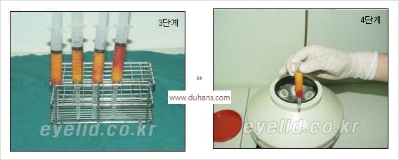 [두한성형외과 경쟁력 눈밑성형] - [눈밑 다크써클 수술 방법] 관련 이미지 7