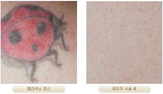 Duhan Plastic Surgery Laser Treatment - Mole Removal, Spot Removal, Melasma, Blemishes, Hyperpigmentation, Skin Tone Improvement, Elasticity Improvement, Skin Texture Improvement image 30