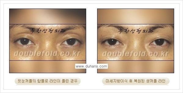 [두한성형외과 경쟁력 쌍꺼풀 재수술, 극한 재수술] - [미세지방이식으로 풀린 쌍꺼풀 교정] 관련 이미지 4