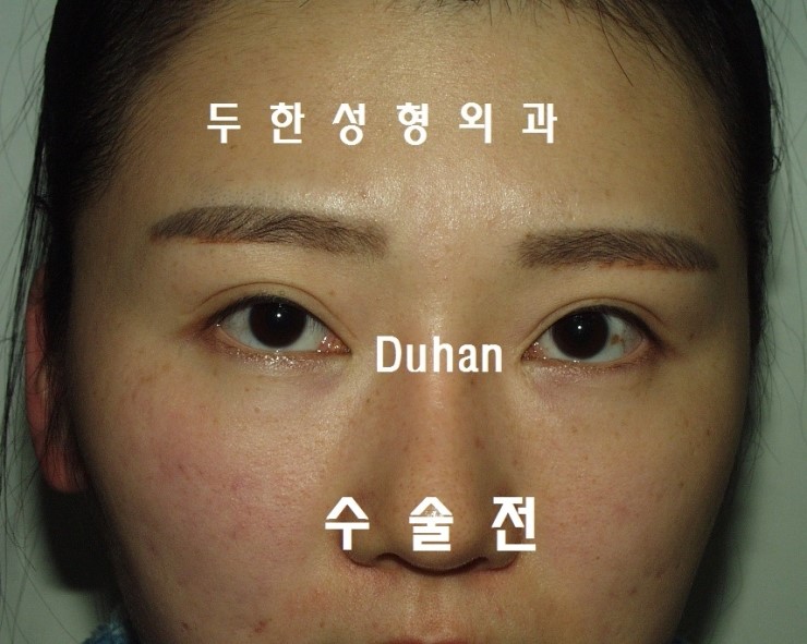 #아웃라인 #비대칭라인 에서 #인아웃라인 으로 #쌍꺼풀재수술 #다크써클 관련 이미지 1